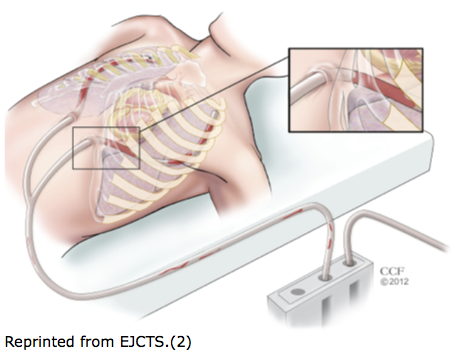 chest tube