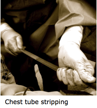 Chest Tube Stripping