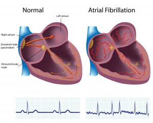 AFib-shutterstock_89144557